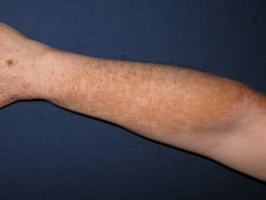rechterarm vitiligo voor